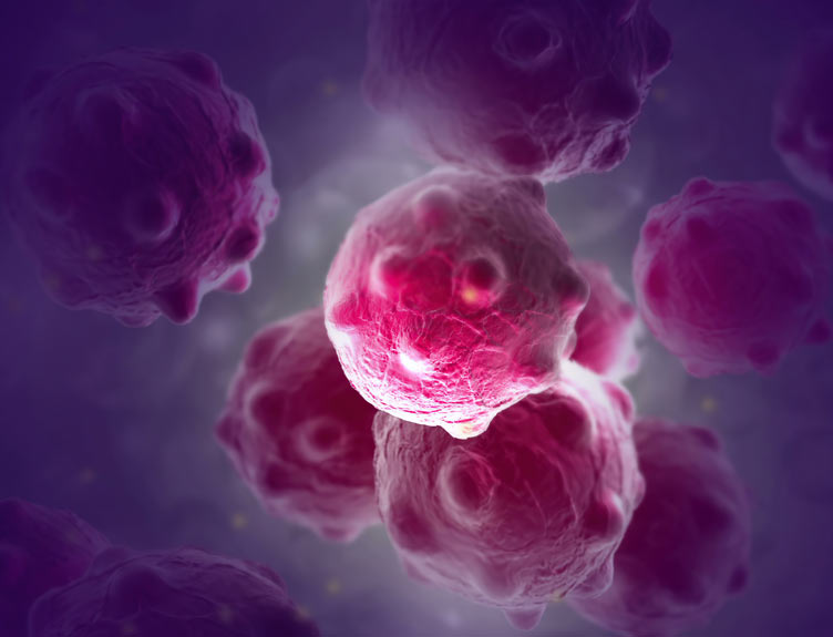 Bacteria and bowel cancer