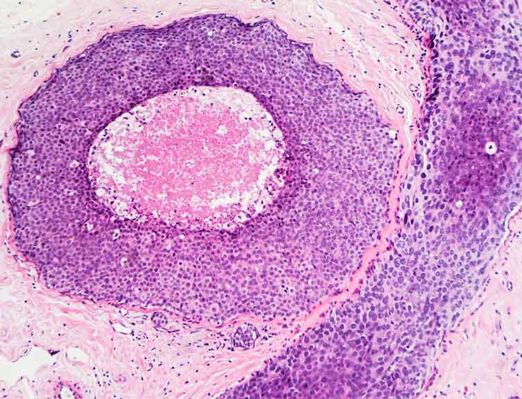 Breast cancer cells within mammary ducts.