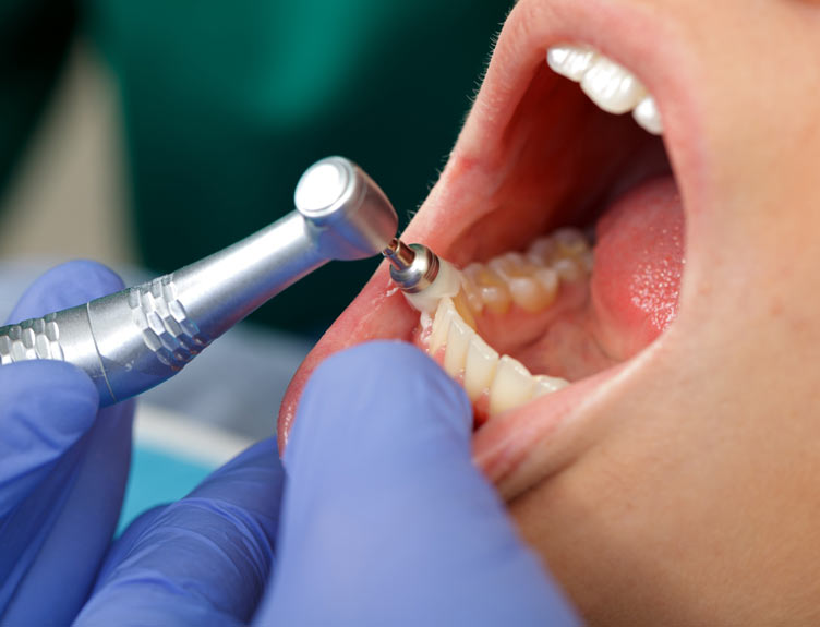 Close up of a professional dental brushing at the clinic