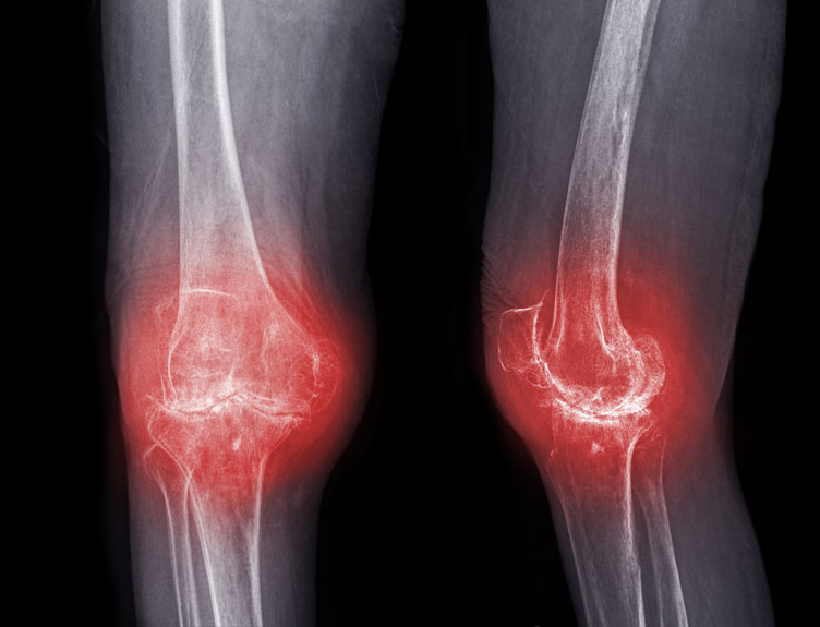 Illustration of an X-ray of legs with red markers to indicate pain.