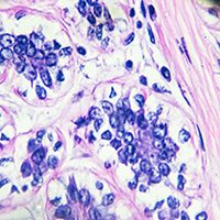 breast cancer