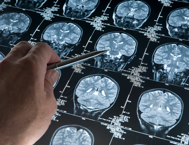 MRI brain scan