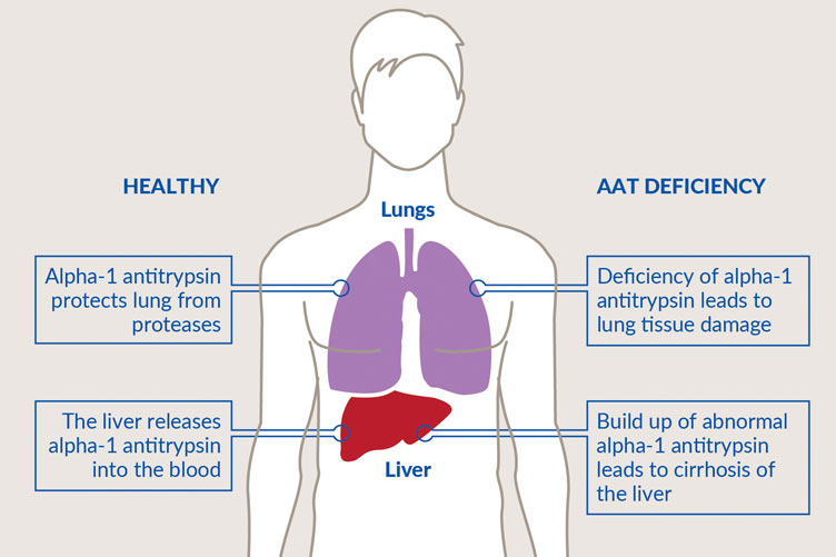 Graph with information on alpha-1 antitrypsin deficiency